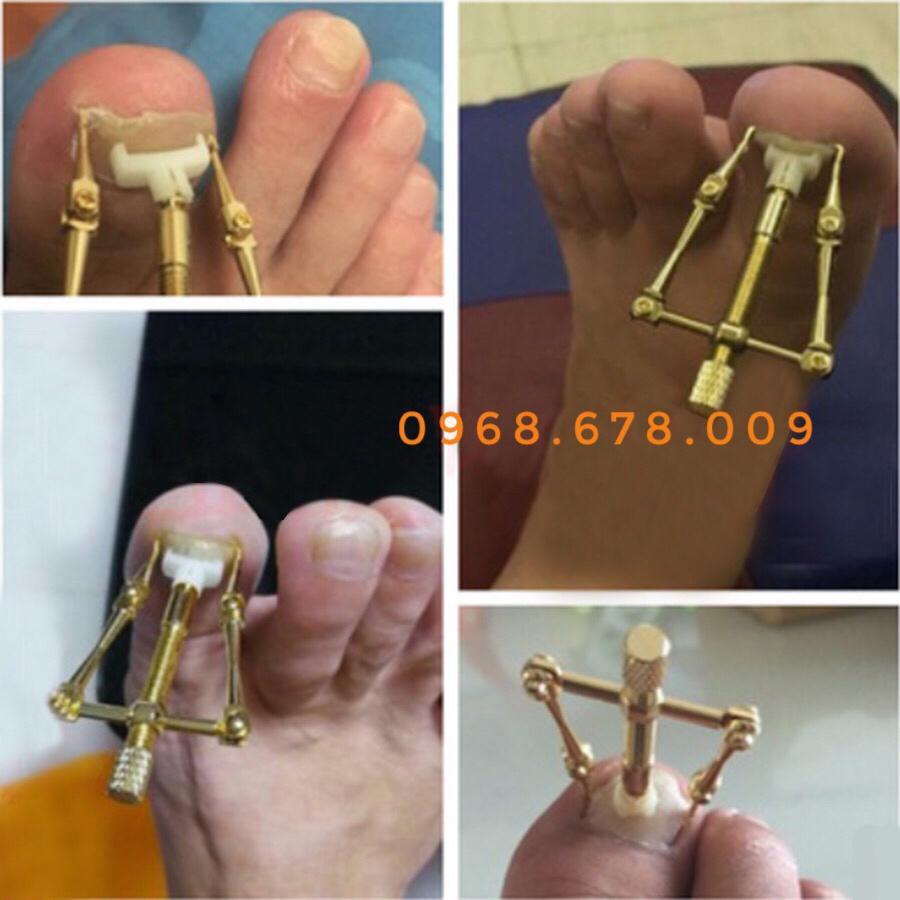 Bộ dụng cụ chữa móng chân bị chọc thịt gây tổn thương đau đơn -móng chân bị quặp thịt