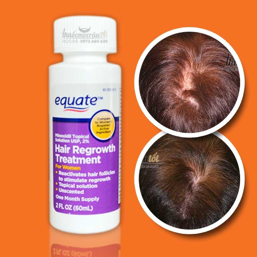 Thuốc mọc t&oacute;c, mọc l&ocirc;ng m&agrave;y Minoxidil 2% cho nữ