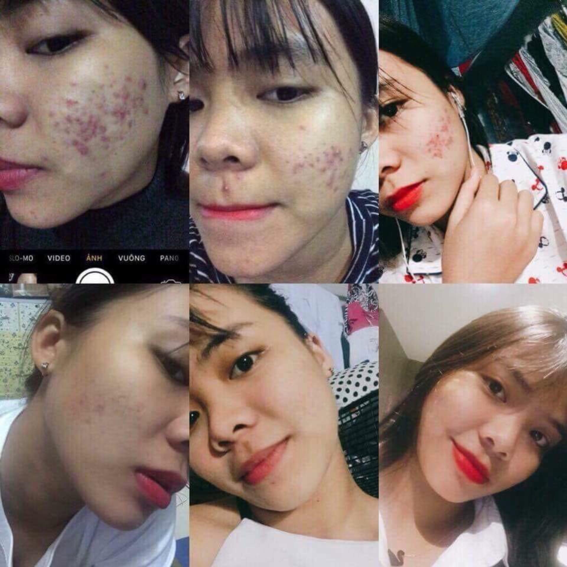 TRỊ MỤN _ SẸO RỖ