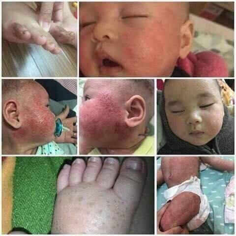 Kem bôi da liễu ( nấm, lang ben, hắc lào, mẩn ngứa, rôm sảy, viêm da cơ địa)