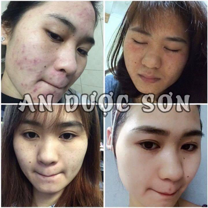 Bộ serum giảm mụn thâm sẹo rỗ An Dược Sơn combo 30ML+50ML