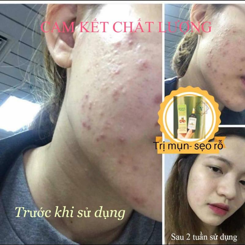 Thảo dược tái tạo da gia truyền ( Liệu trình 1 tháng) nhập khẩu