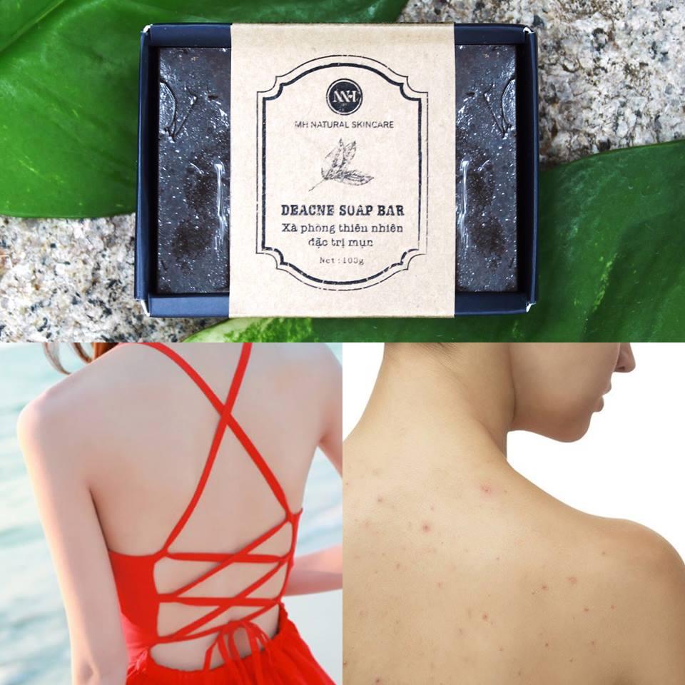 Xà phòng trị mụn lưng ngực MH Deacne soap bar 100g