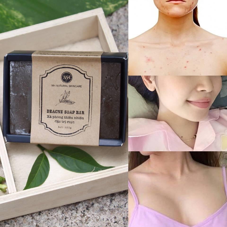 Xà phòng trị mụn lưng MH Deance soap bar 100g