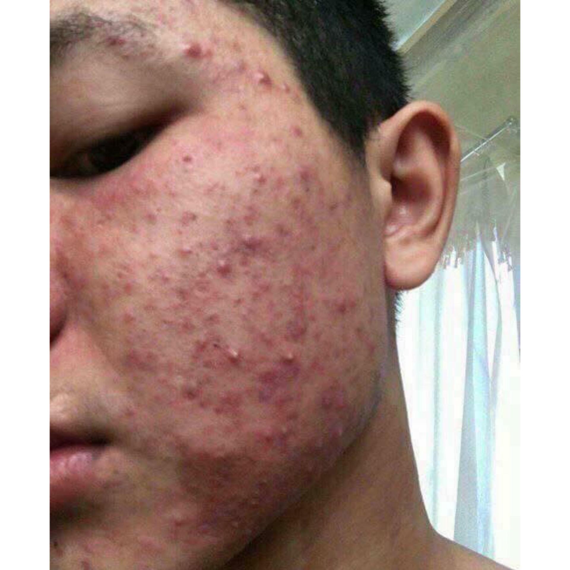 Trị mụn vĩnh viễn