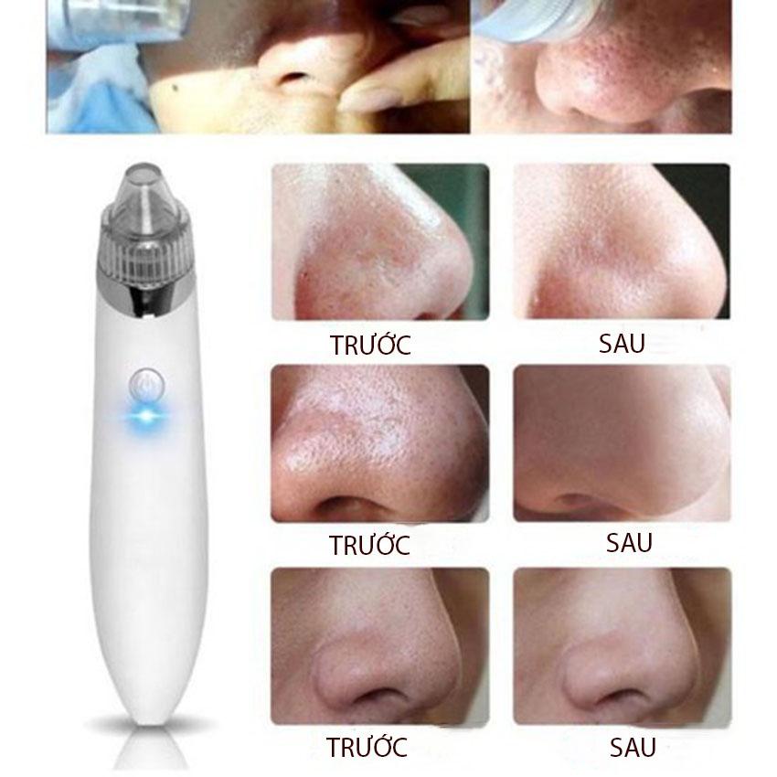 Cách trị mụn nam, Thuoc dieu tri mun, Máy hút mụn MINI, Giảm giá sốc, Bảo hành uy tín bởi Mega Shop, Mấu494