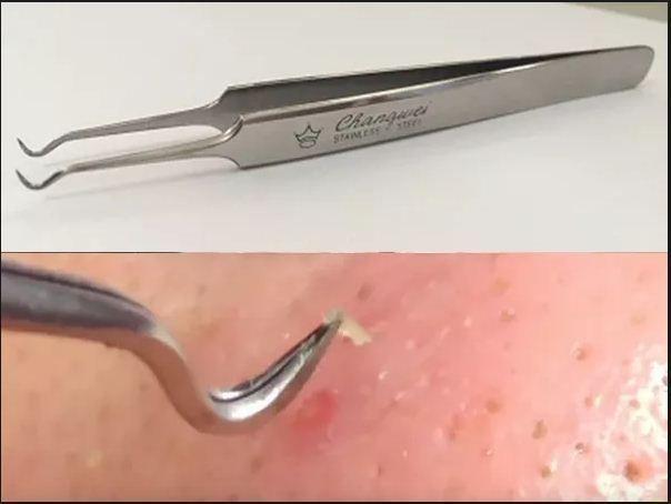 [Hàng đẹp] Nhíp gắp mụn cám Hàn Quốc