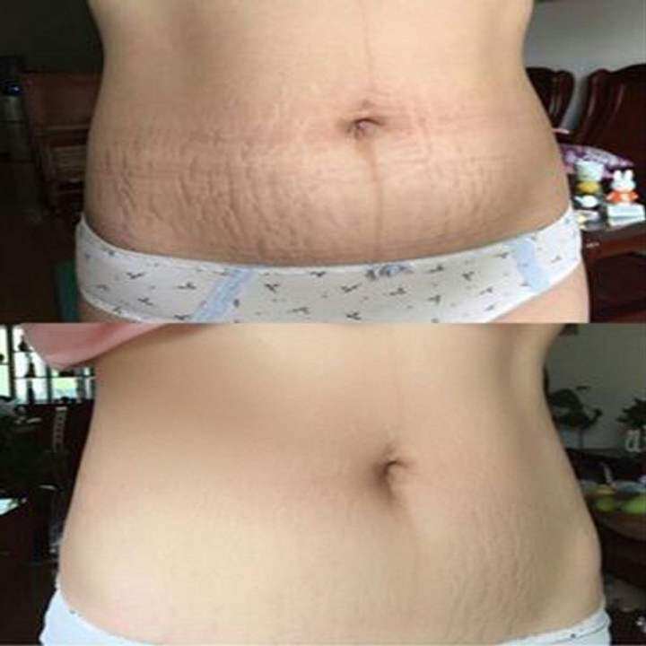 Kem làm mờ rạn da tri scar cream, kem xóa vết rạn, dưỡng trắng da, làm mờ sẹo mụn, xóa sẹo, phục hồi da mặt, tai, chân, sẹo mụn, sẹo bỏng 30g