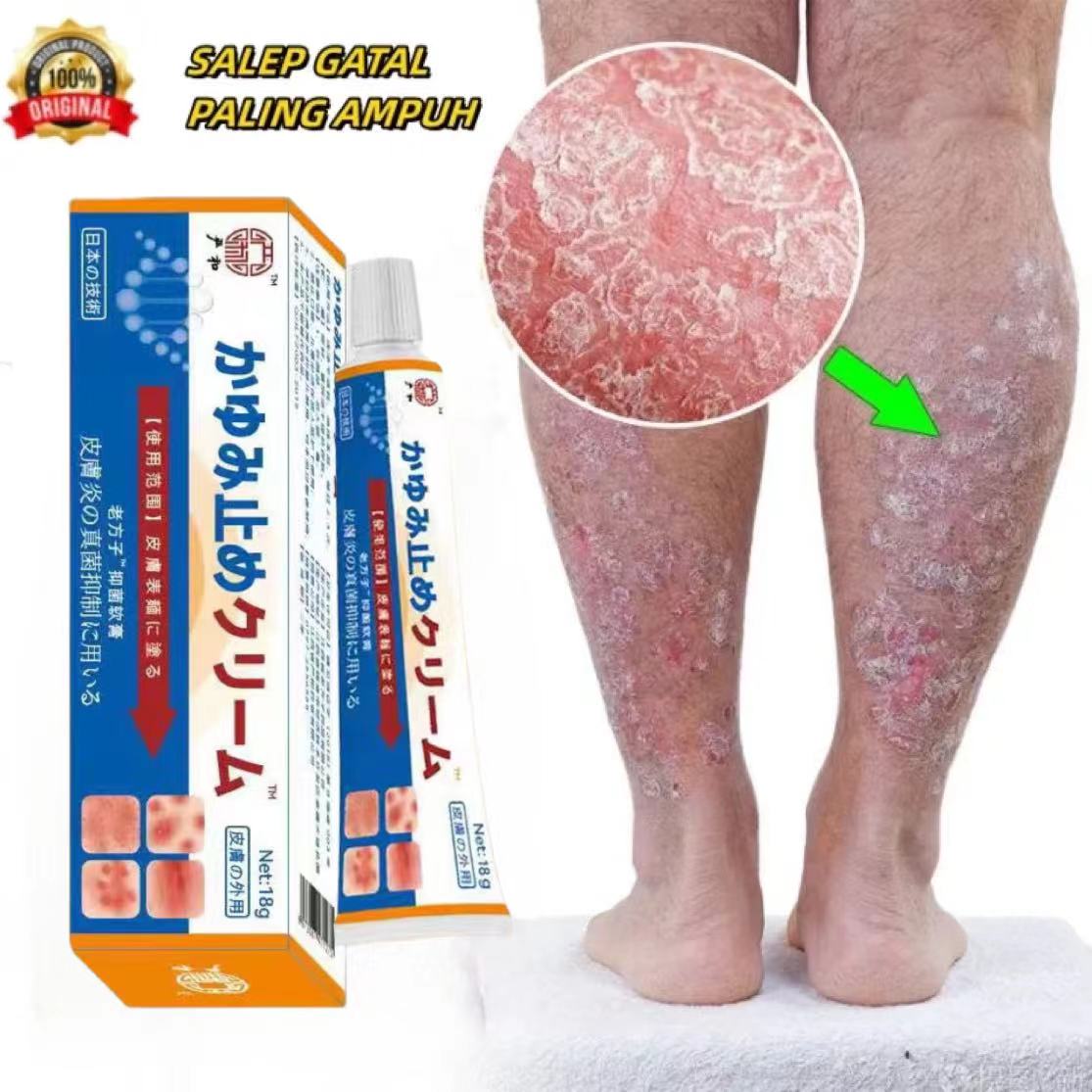  kem bôi nấm ngứa nhật bản kem bôi nấm ngứa thuốc bôi nấm ngứa thuốc trị lang ben viêm da cơ địa thuốc nấm kutieskin trị nấm candida thuốc dị ứng 