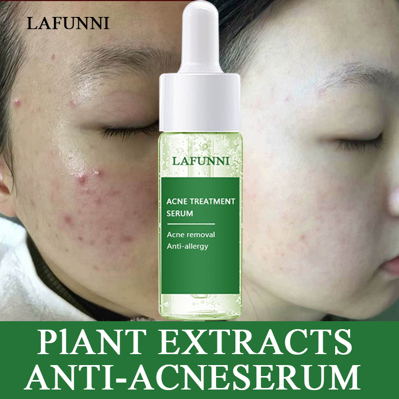 LAFUNNI Mặt Nạ Huyết Thanh Điều Trị Mụn Trứng Cá, Loại Bỏ Sẹo Mụn Trứng Cá Tinh Chất Dưỡng Ẩm Làm Trắng Da Chăm Sóc Da Mặt