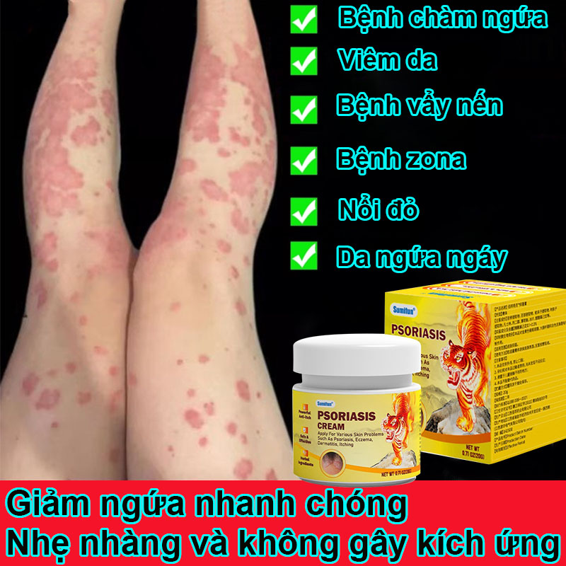 Kem bôi nấm da kem bôi á sừng kem bôi da liễu kem bôi nấm ngứa vảy nến nứt gót chân mẩn ngứa rôm sảy viêm da cơ địa lang ben. kem bôi ngoài da kem bôi da liễu ngoài da