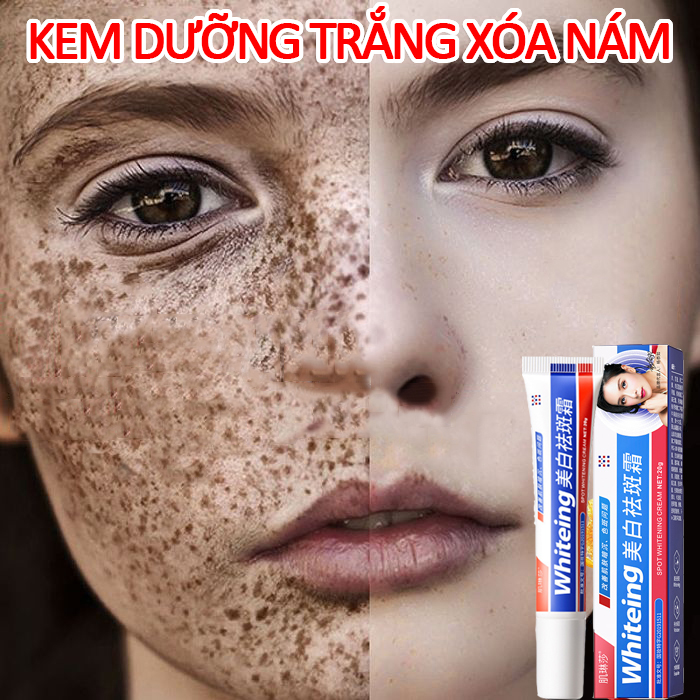 Kem trắng da và xóa tàn nhang Kem xóa tàn nhang đồi mồi Tinh chất làm trắng sạch tàn nhang Hiệu quả làm mờ thâm nám tàn nhan kem thâm nám tàn nhang đồi mồi