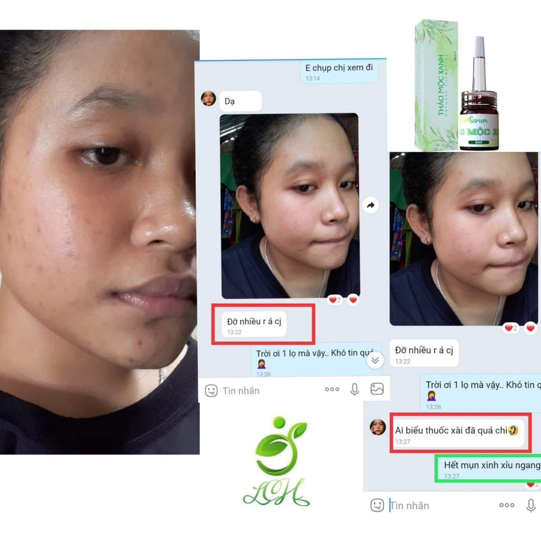 Trị mụn thảo mộc xanh