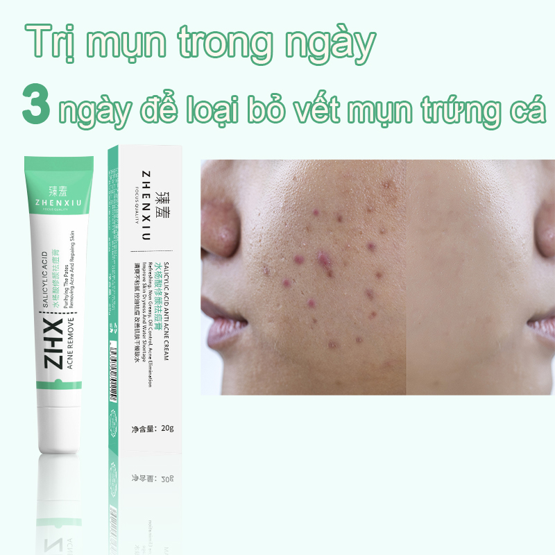 Kem Hết Mụn Kem Giảm Mụn Trứng Cá Kem chấm mụn hiệu quả hết mụn Loại Bỏ Mụn và Vết Thâm Hoàn Toàn