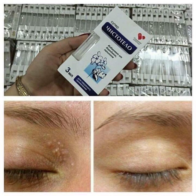 Tẩy mụn ruồi mụn thịt nga