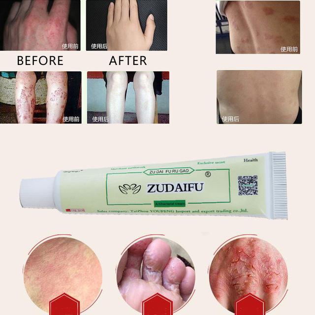 [hcm]zudaifu natural chinese herbal medicine cream eczema dermatitis psoriasis vitiligo antibacterial skin disease treatment 6