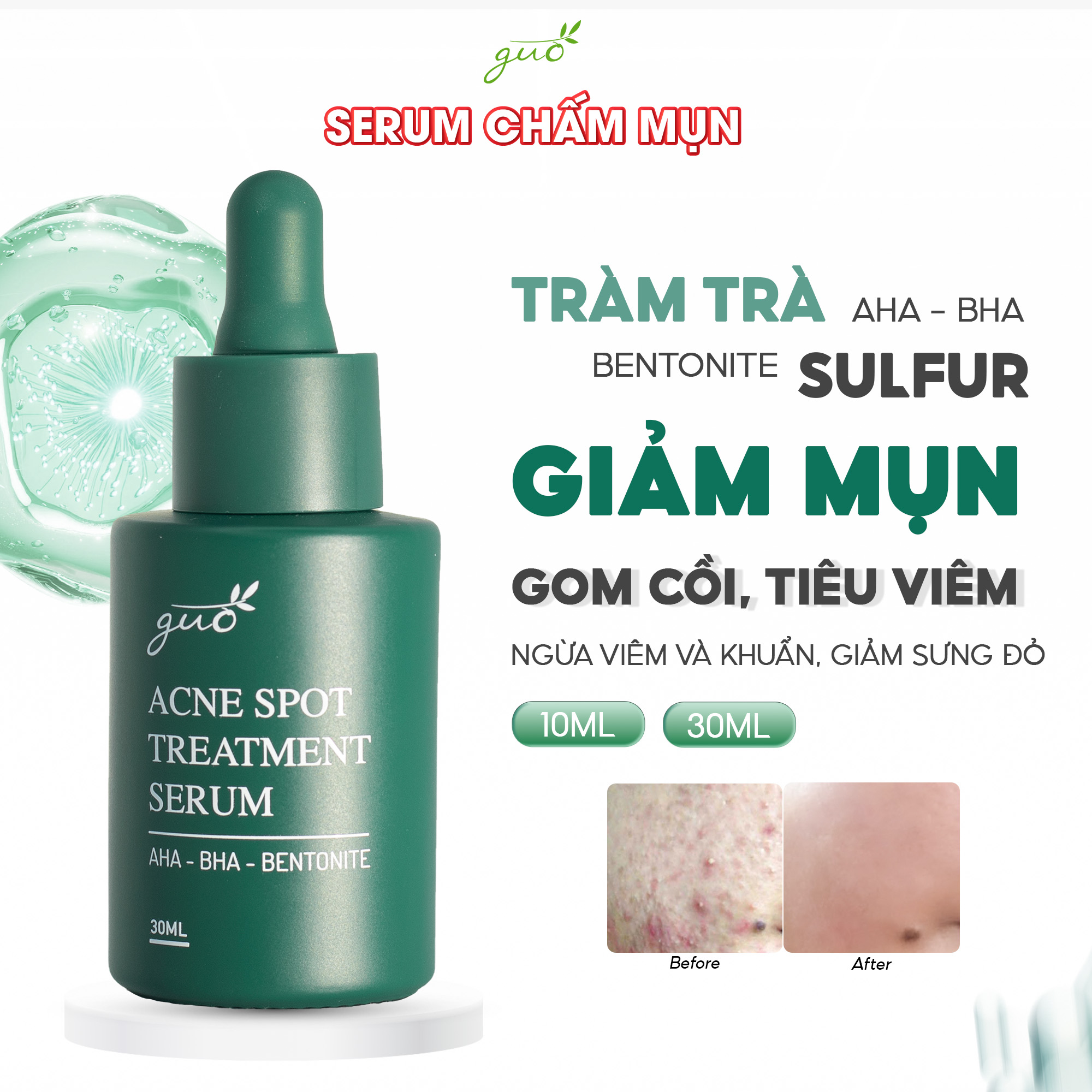 [Serum Gom khô cồi, giảm mụn, mờ thâm sau mụn, 100% Feedback khách tin dùng hiệu quả] Serum Chấm Mụn GUO 30ml