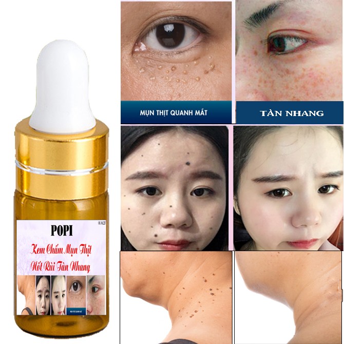 [HCM]Kem Phá Nốt Ruồi Mụn Thịt Tàn Nhang Đồi Mồi Hiệu Quả Sau 7 Ngày