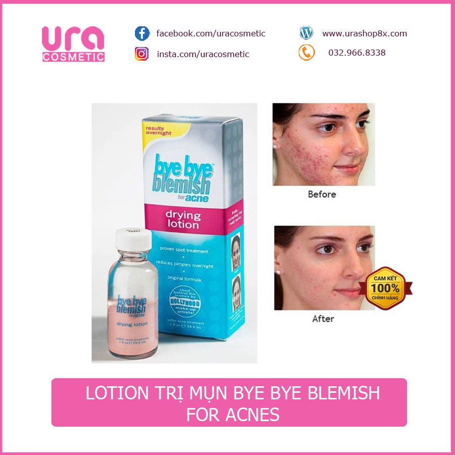 Lotion hỗ trợ giảm mụn Bye bye Blemish Drying Lotion