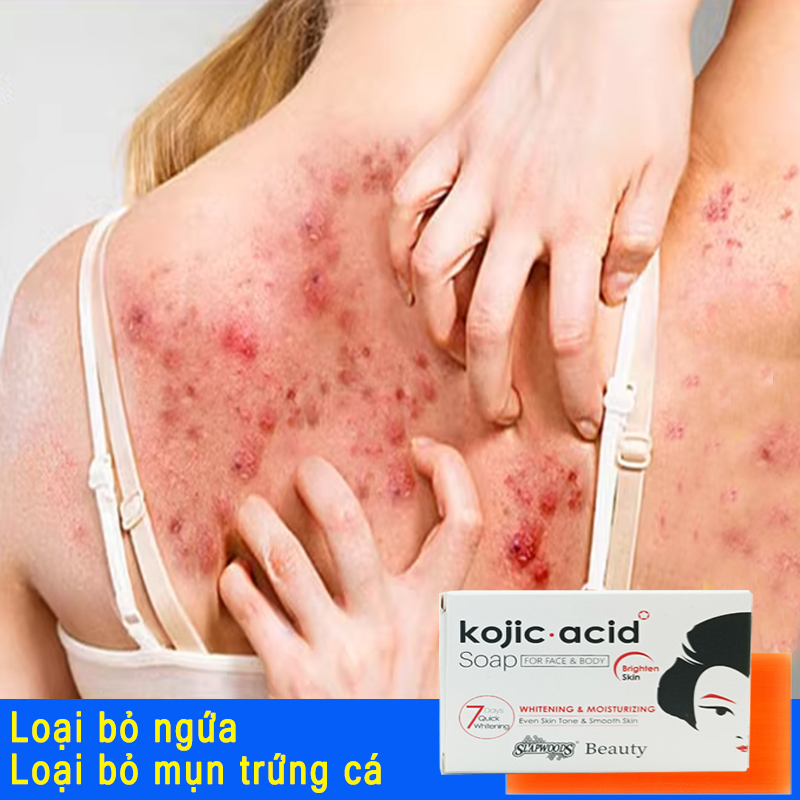 Xà phòng mụn lưng, trắng da viêm nang lông Loại Bỏ Mụn Lưng Làm sạch sâu bụi bẩn dưới da mụn trứn