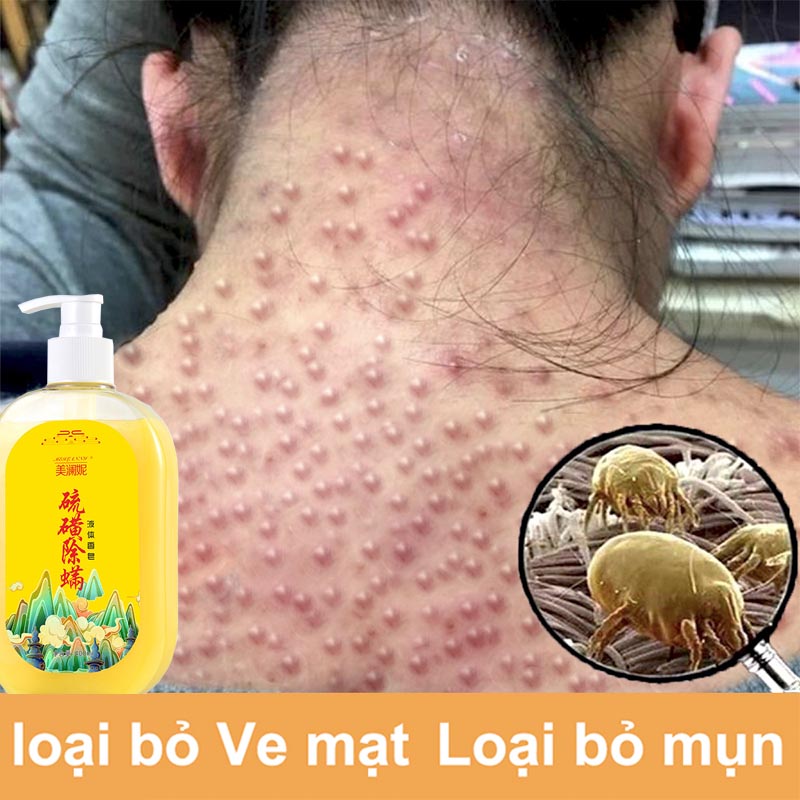Sữa tắm mụn lưng sữa tắm viêm nang lông 400ML Làm sạch sâu bụi bẩn dưới da Cải thiện mụn trứn