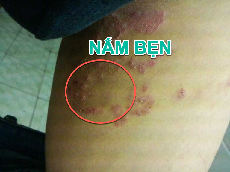 Thảo dược quý bôi chàm ngứa bẹn - nấm háng, hắc lào - lác đồng tiền, vùng bụng đông y cổ truyền