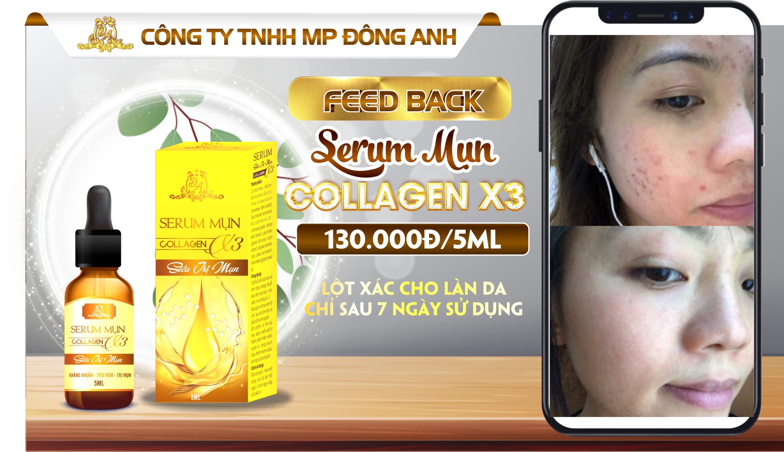 Serum mụn Đông Anh