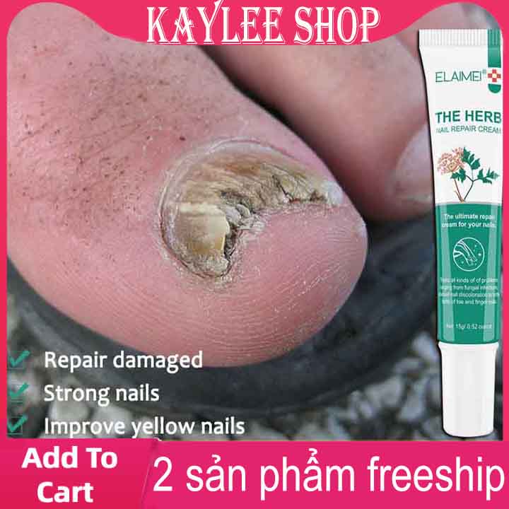 Kem Tẩy Nấm Móng, huyết Thanh Sửa Móng Tay,Gel Tẩy Nấm Chân 15g Loại Bỏ Nấm, nhanh chóng sửa chữa móng bị hư hỏng loại bỏ nấm móng ức chế nhiễm nấm phục hồi sức khỏe móng kem chống nấm kem tẩy nấm móng chăm sóc móng