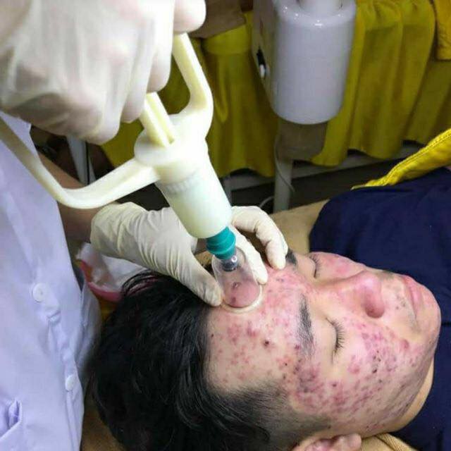 Bộ súng hút máu bầm