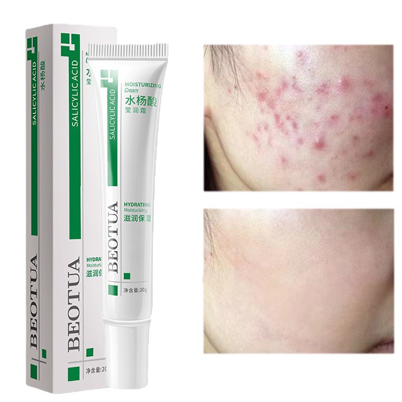 Gel Phục Hồi Mụn Trứng Cá Kem Dưỡng Da Mặt, Loại Bỏ Serum Dưỡng Da Mặt Chống Nhạy Cảm Phục Hồi Nhẹ Tổn Thương, Chăm Sóc Da Trị Mụn