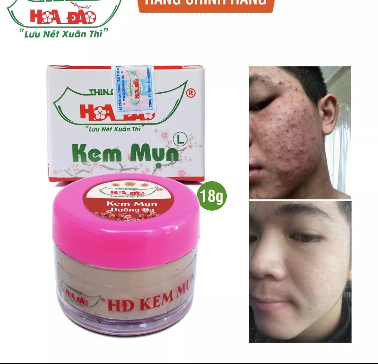 Combo 5 hộp kem mụn hoa đào 18 gram
