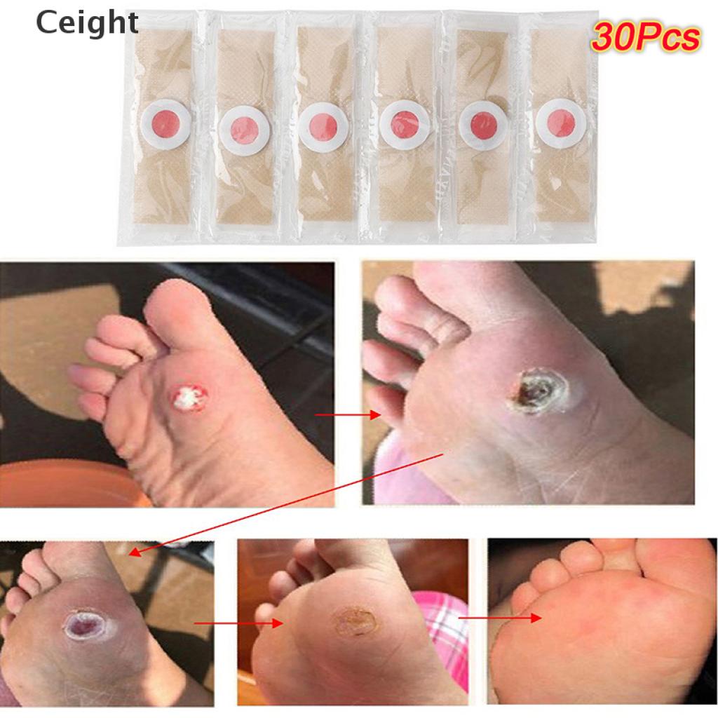 5 miếng dán tẩy mụt cóc nhanh hiệu quả cao