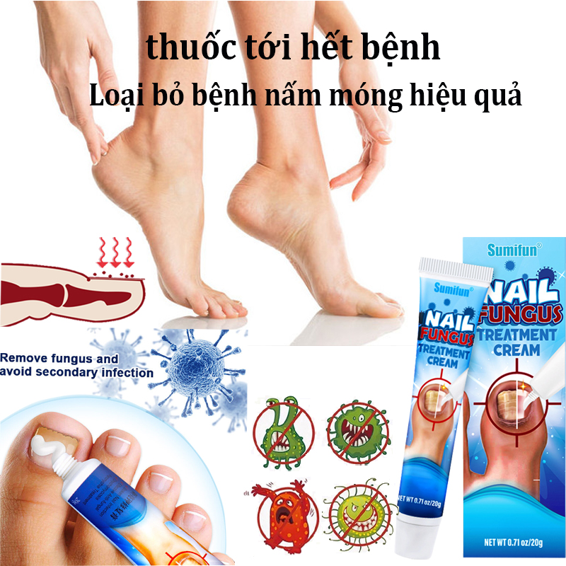 Nấm móng móng chân móng chân nấm Kem Loại Bỏ Nấm Móng 20G loại bỏ nấm móng viêm mé kháng khuẩn tiêu viêm ngăn ngừa các loại nấm, chân nấm dùng cho cả nam và nữ