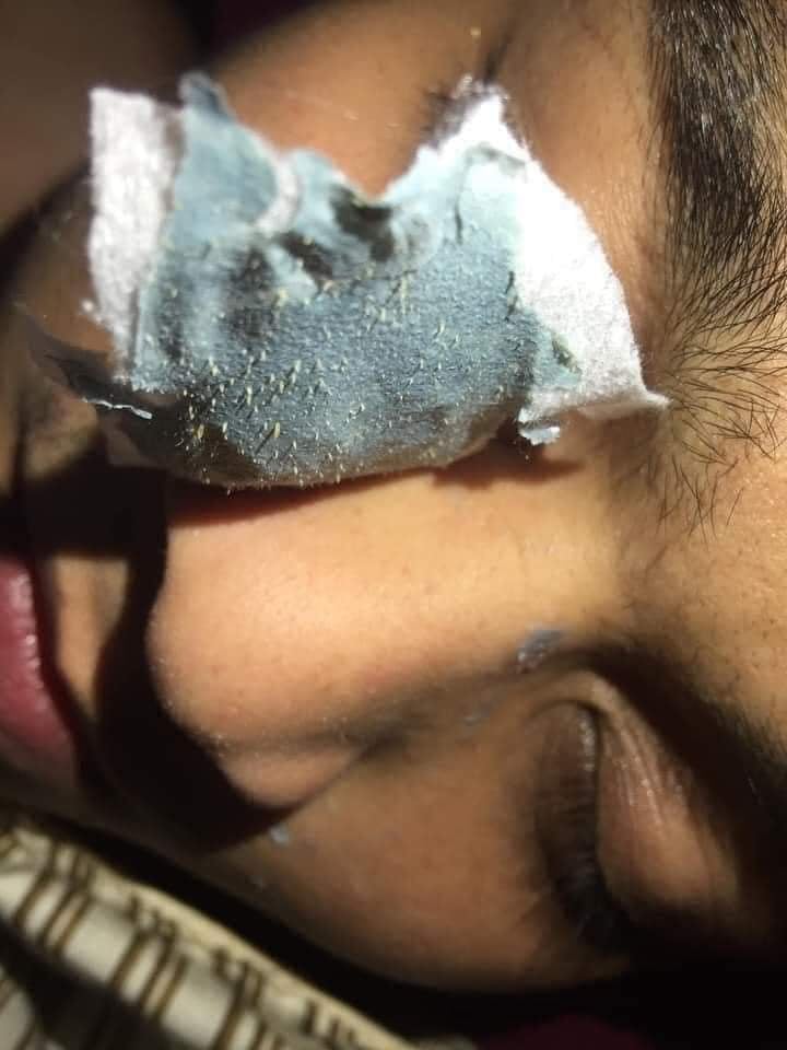 Gel Lột Mụn Dr.ACNE cty HAI AU VIET