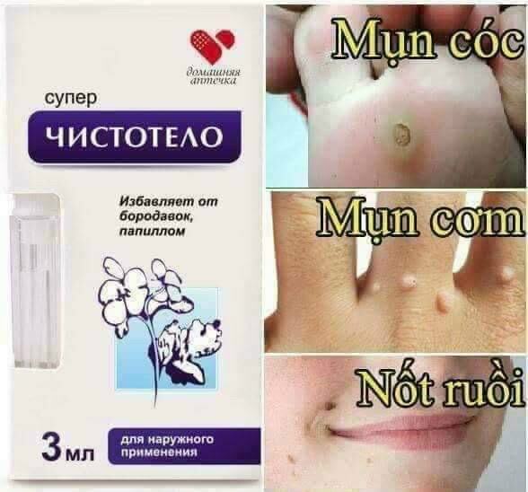 Mụn ruồi nga, mụn cơm nga, mụn cóc nga