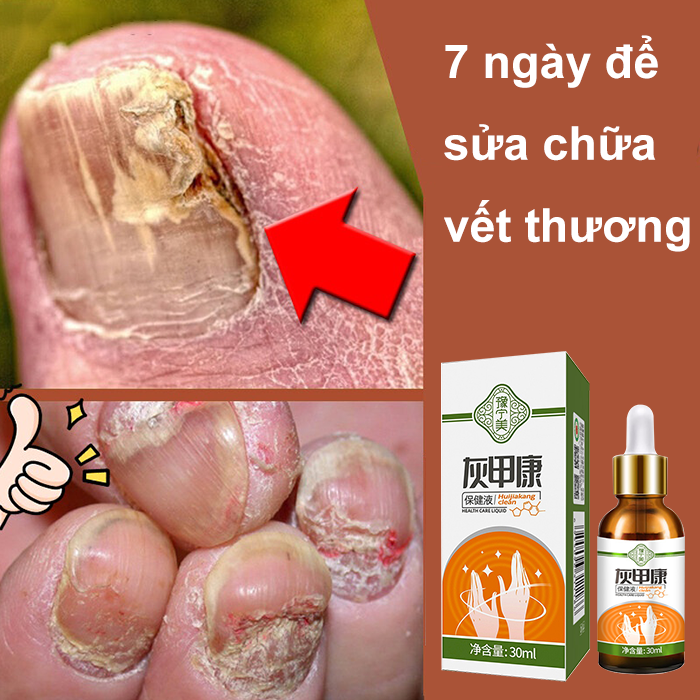 Làm lành hư móng chân kem loại bỏ nấm móng tay chân hư nấm móng chân 20ml