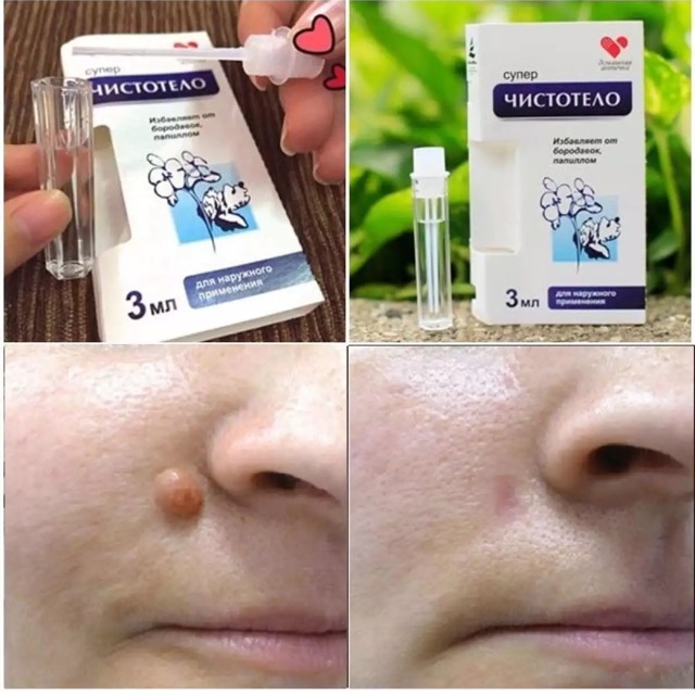Gel tẩy nốt ruồi mụn cóc