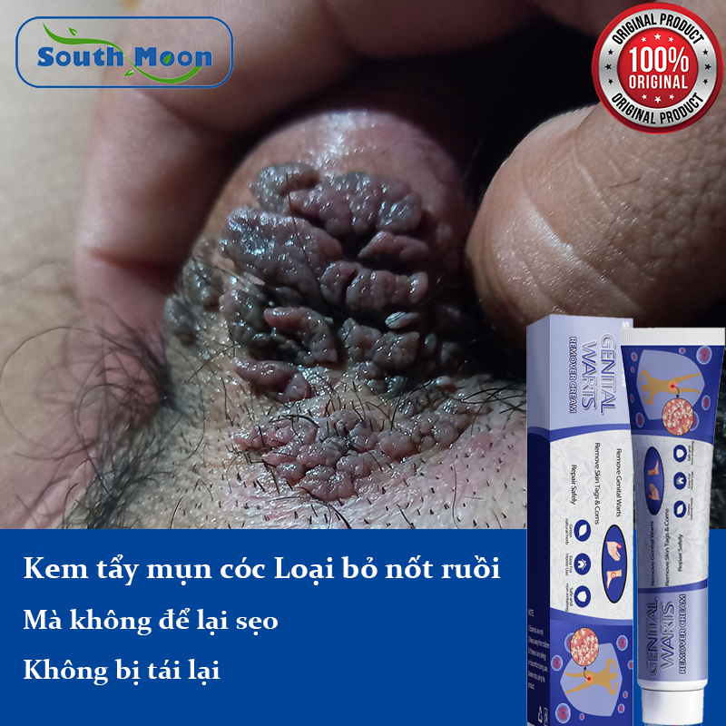 Kem xoá mụn cóc , mụn thịt , loại bỏ mụn cóc thông thường ,mụn đá , mụn cơm ,mụn cóc dạng sợi