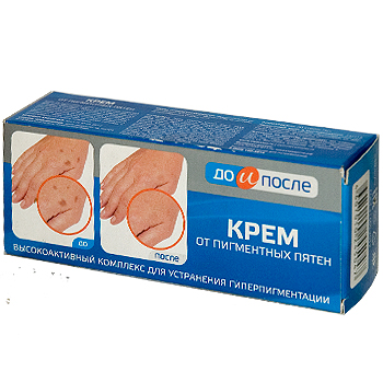 Kem trị đồi mồi tay -trị nám -tàn nhang đốm nâu tay kpem nga