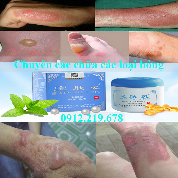 Kem bôi bỏng Bảo Phú Linh