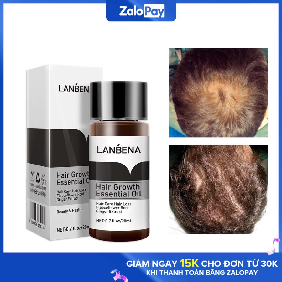 Tinh Chất Kích Thích Mọc Tóc Dưỡng Tóc Chuyên Sâu Mọc Nhanh Giảm Gãy Rụng Lanbena Hair Growth Oil 20Ml