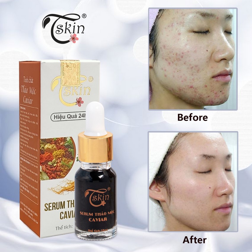 Serum mụn thâm dưỡng trắng da cấp ẩm phục hồi da vitamin C niacinamide Caviar 10ml