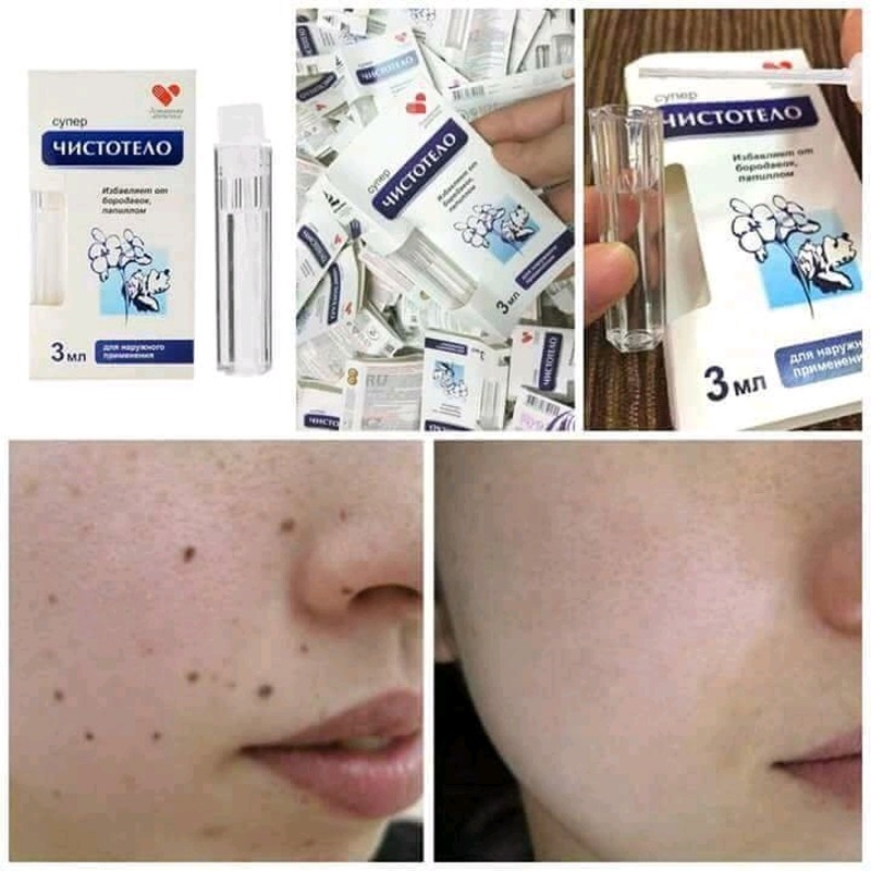 Gel TẨY NỐT RUỒI, MỤN CÓC, MỤN THỊT, SẸO LỒI - NGA GEL DVELINIL -