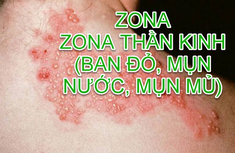 Thảo Dược BÔI HẾT_Giời Leo_Zona thần kinh_Mụn bóng nước, Ban đỏ, Ngứa rát lan theo vết ngứa