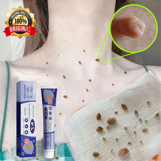 Mụn cóc kem loại bỏ mụn cóc loại bỏ nốt ruồi sạch mụn thịt thừa mụn cóc mụn nốt duồi và các mụn li ti quanh mắt 20g