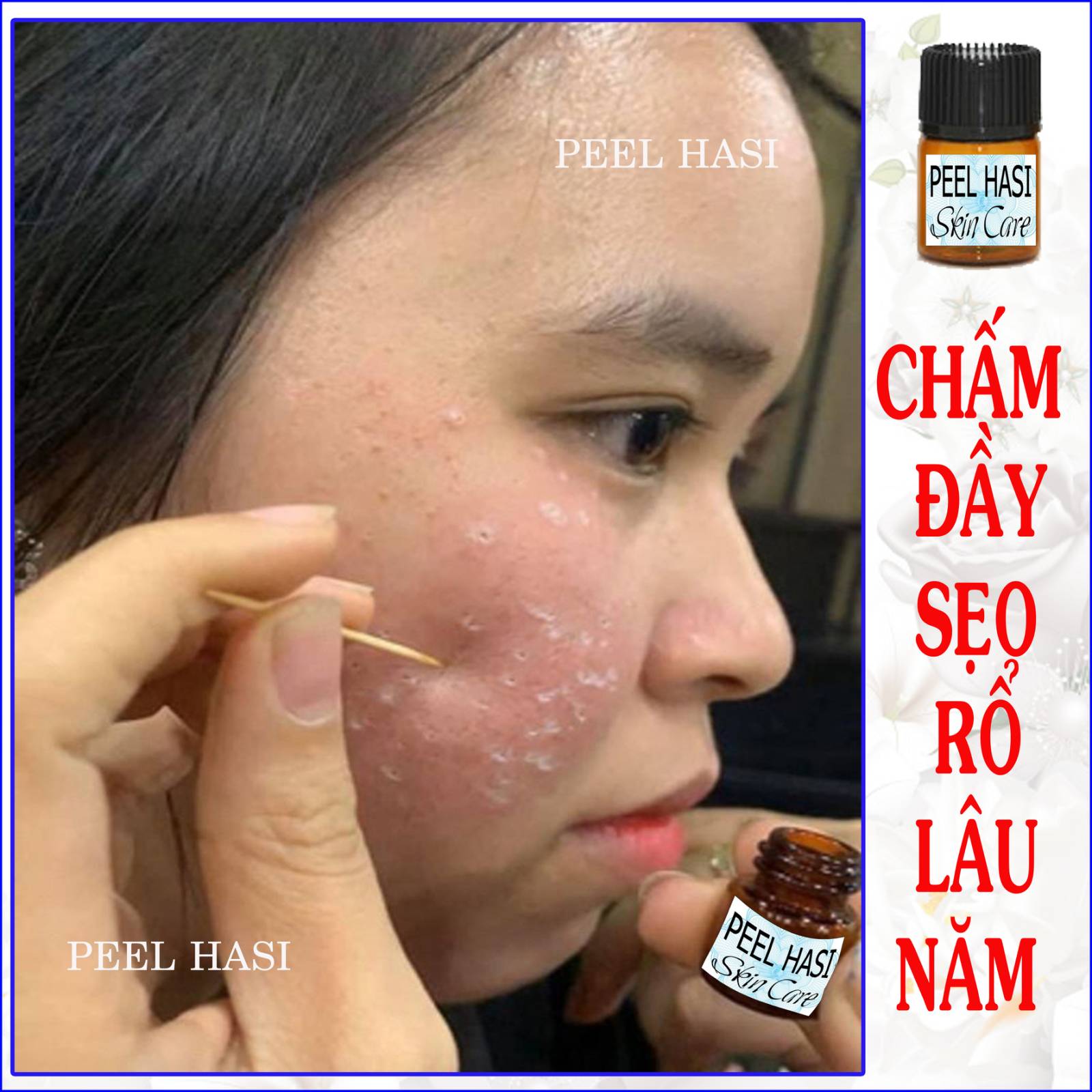 Chấm đầy sẹo rỗ lâu năm. chấm tàn nhang. quét hết nám peel hasi