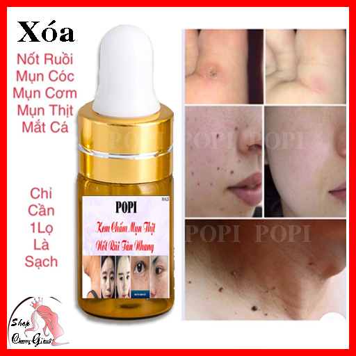 KEM POPI XÓA, MỤN CÓC, NỐT RUỒI, MỤN THỊT, TÀN NHANG ( hiệu quả sau 3 -5 ngày