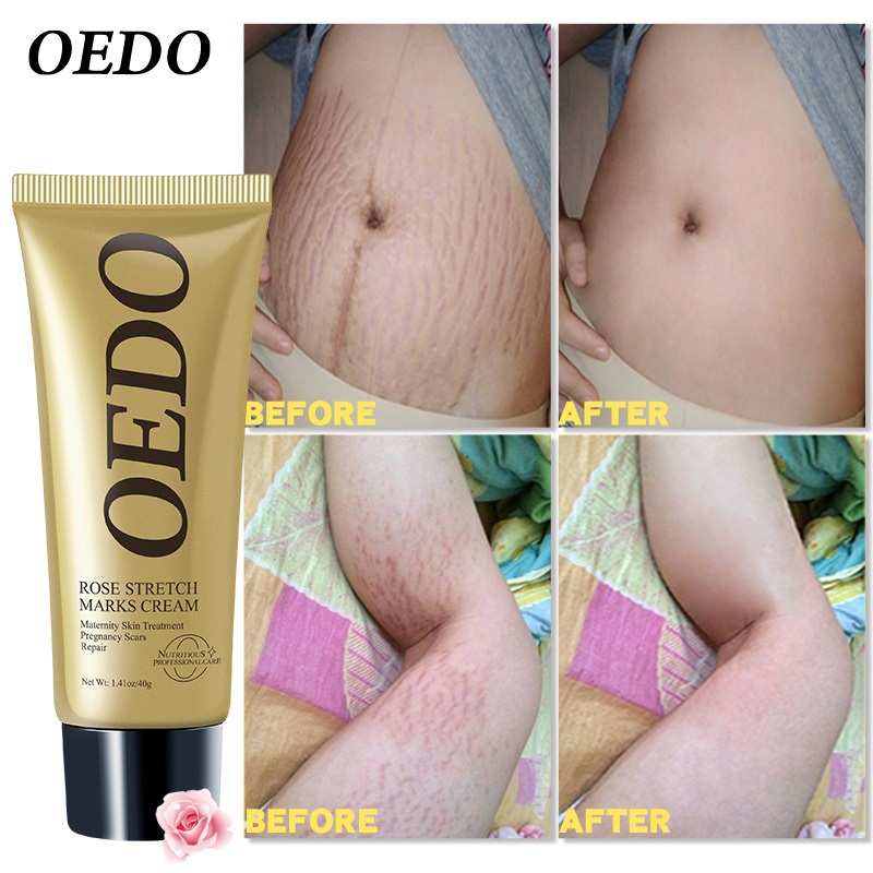 Kem rạn da Kem xóa nhăn Kem Phục Hồi Sau Sinh 40g Kem rạn da chống rạn da cho bà bầu làm mờ vết rạn sau sinh làm săn chắc da cho bà bầu làm hết mờ sẹ