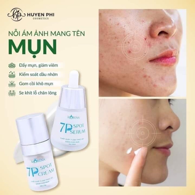 SERUM KEM CHẤM MỤN 7P GIÚP GIẢM MỤN , MỜ THÂM [hoàn toàn bằng thảo dược thiên nhiên,ngừa mụn kháng khuẩn đánh bay mụn, không xưng không đau. mụn cám, mụn ẩn mụn bọc mụn mủ, an toàn cả phụ nữ mang thai ] CAM KẾT HÀNG CHÍNH HÃNG