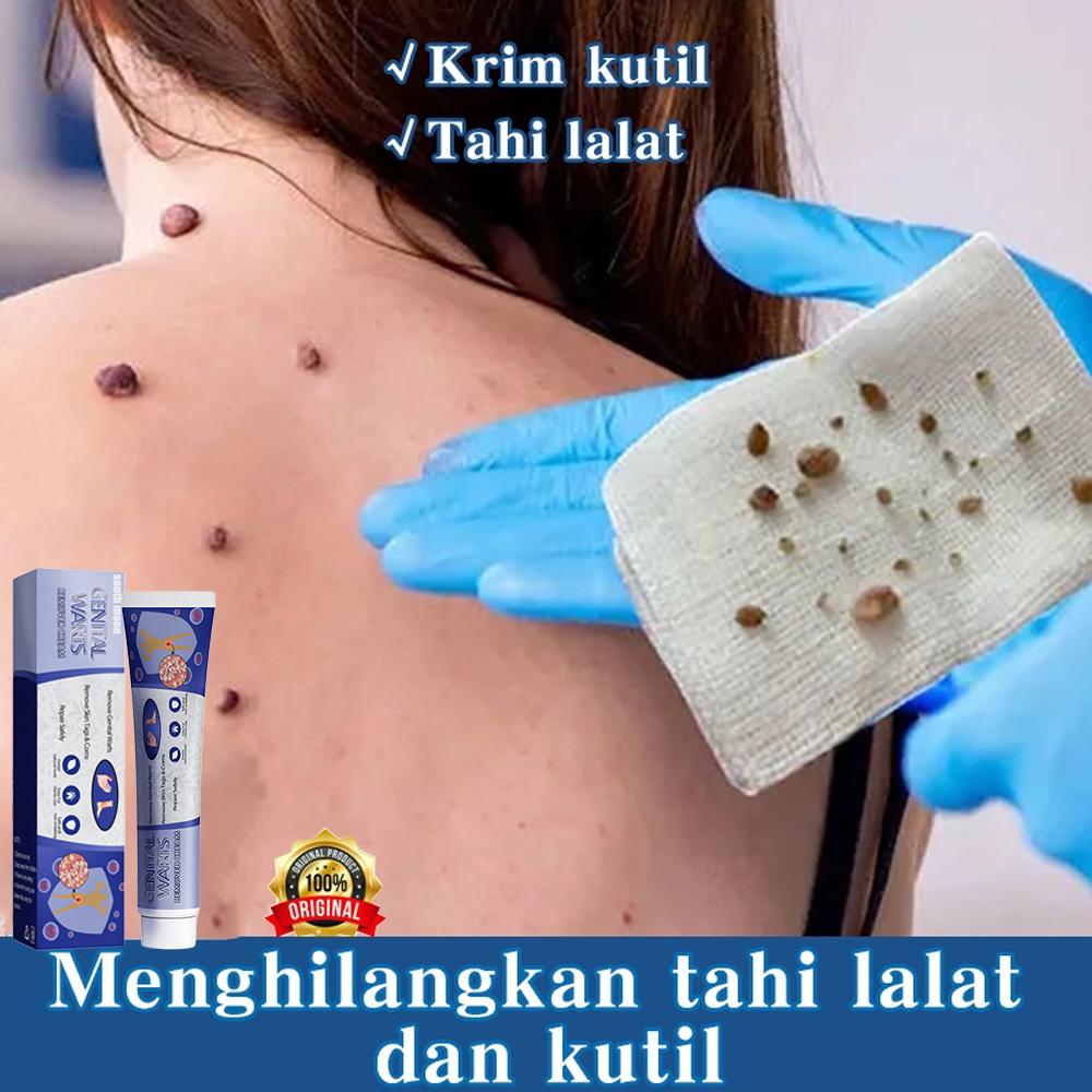 Kem tẩy nốt ruồi trị mụn cóc kem mụn cóc 7 ngày loại bỏ mụn cóc nhanh chóng Loại bỏ mụn cóc an toàn và không đau 20ml